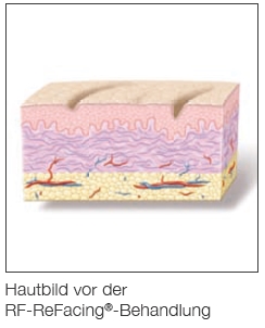 RF-ReFacing Bild 1