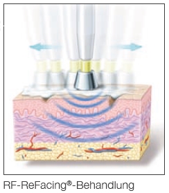 RF-ReFacing Bild 2